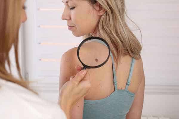 What Are Traditional Skin Lesion Removal Methods Twickenham?