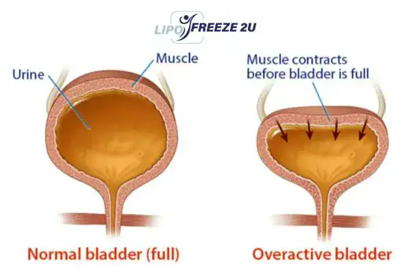 diagram of overactive bladder treatment Twickenham