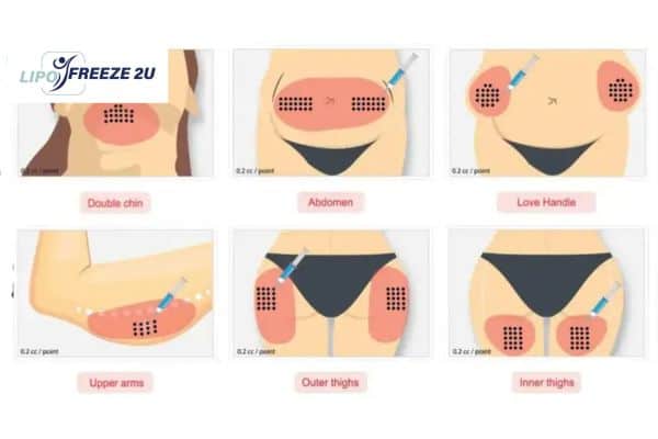 Benefits of Choosing Aqualyx for Fat Reduction Twickenham