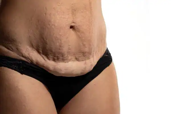 loose skin after weight loss injections Twickenham