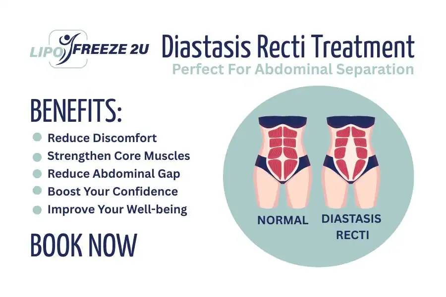 Benefits of body toning treatment Twickenham for Diastasis recti