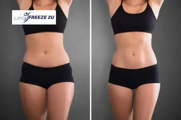 How Can LIPO FREEZE 2U Support Your Post-Pregnancy Body Recovery Twickenham?