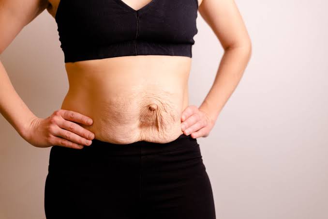 Is Surgery Really the Only Way to Repair Diastasis Recti Twickenham?