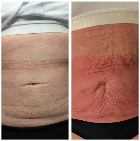 How Does RF Microneedling Improve Crepey, Thin and Uneven Skin Texture Twickenham?
