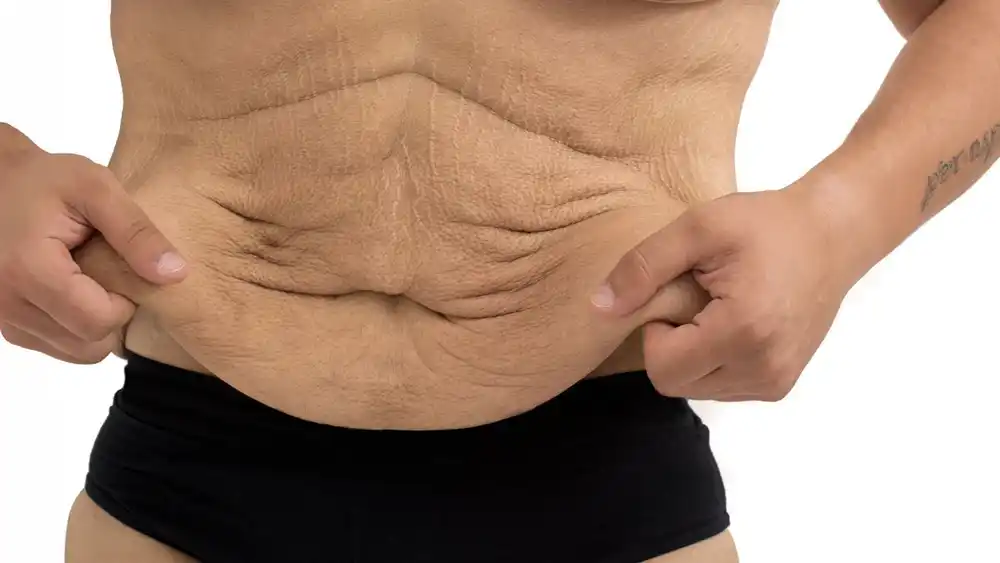 Why Does Weight Loss Medication Leave Some People With Loose or Sagging Skin Twickenham?